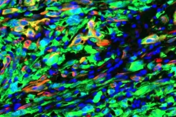 UNE PREMIERE MONDIALE dans la recherche contre le cancer : un nouveau médicament pour lutter contre la progression tumorale