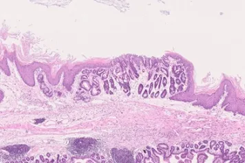 Cancer de l'oesophage : découverte des mécanismes impliqués