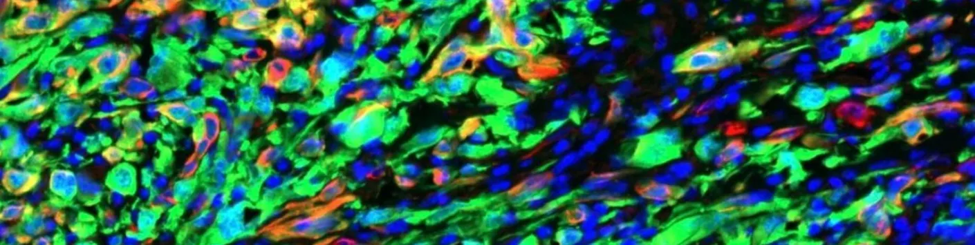 UNE PREMIERE MONDIALE dans la recherche contre le cancer : un nouveau médicament pour lutter contre la progression tumorale