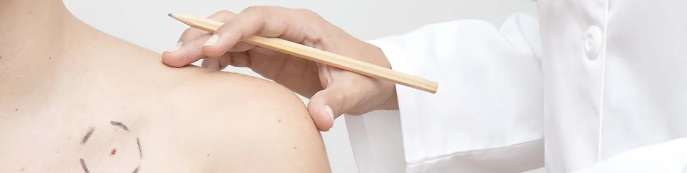 Les mélanomes résistants finiront  par rendre les armes