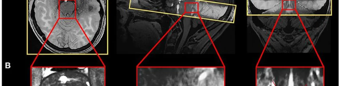 Caractérisation structurelle et fonctionnelle du locus coeruleus chez les jeunes et les personnes d'âge moyen avancé