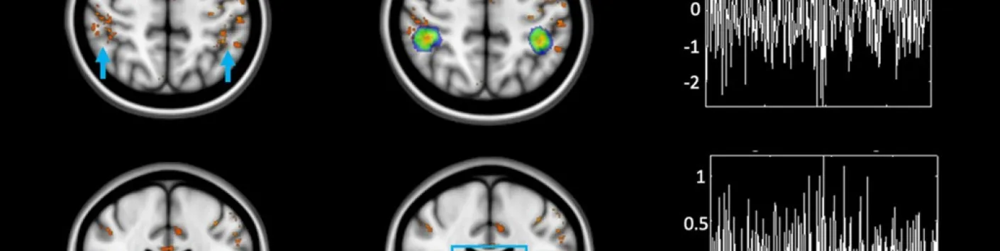Les rôles du locus coeruleus et du thalamus sur notre sommeil et la stimulation de notre cerveau