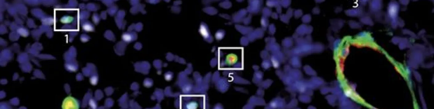 PUBLICATION SCIENTIFIQUE | Nouvelle immunothérapie pour vaincre le cancer