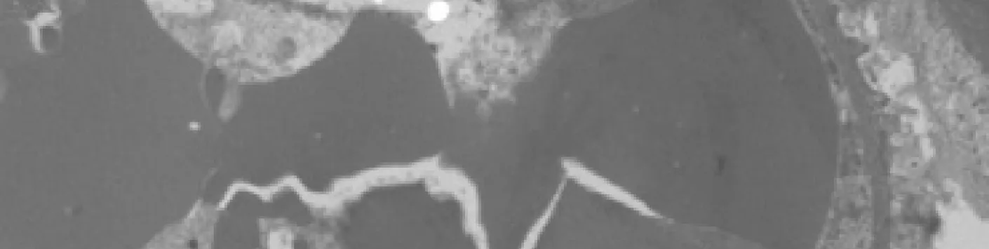 ? Atteinte rénale : difficulté diagnostique des MGRS 